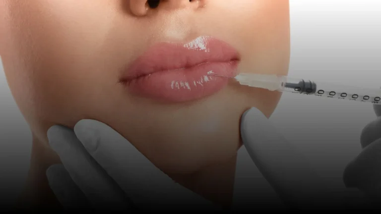 Dermal fillers in Tulum for lips, cheeks and facial contouring