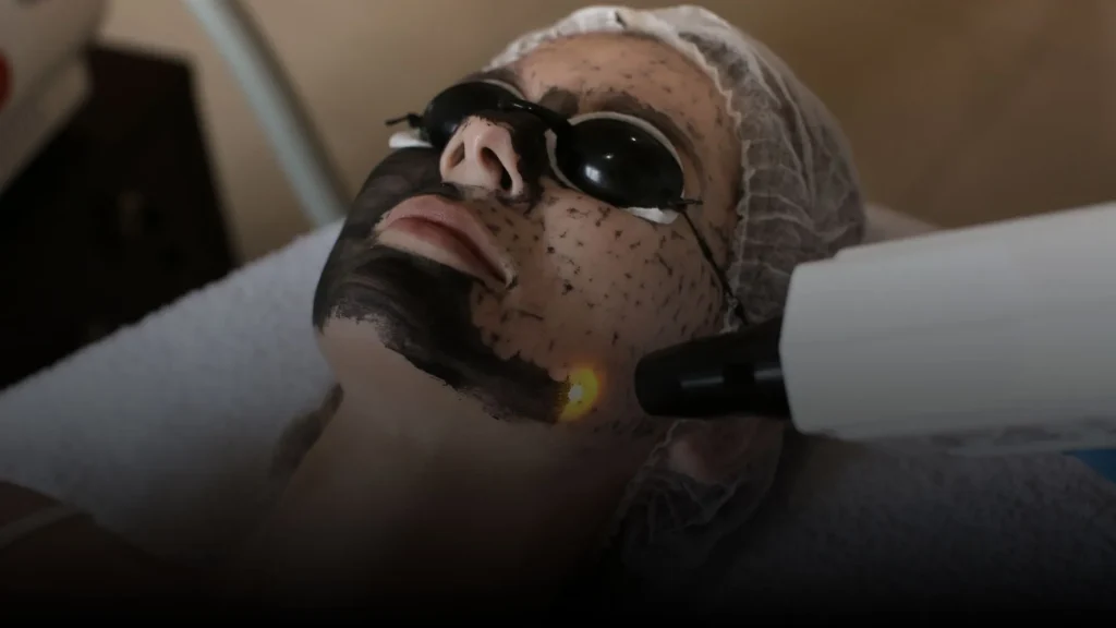 Hollywood carbon laser peel in Tulum for glowing skin