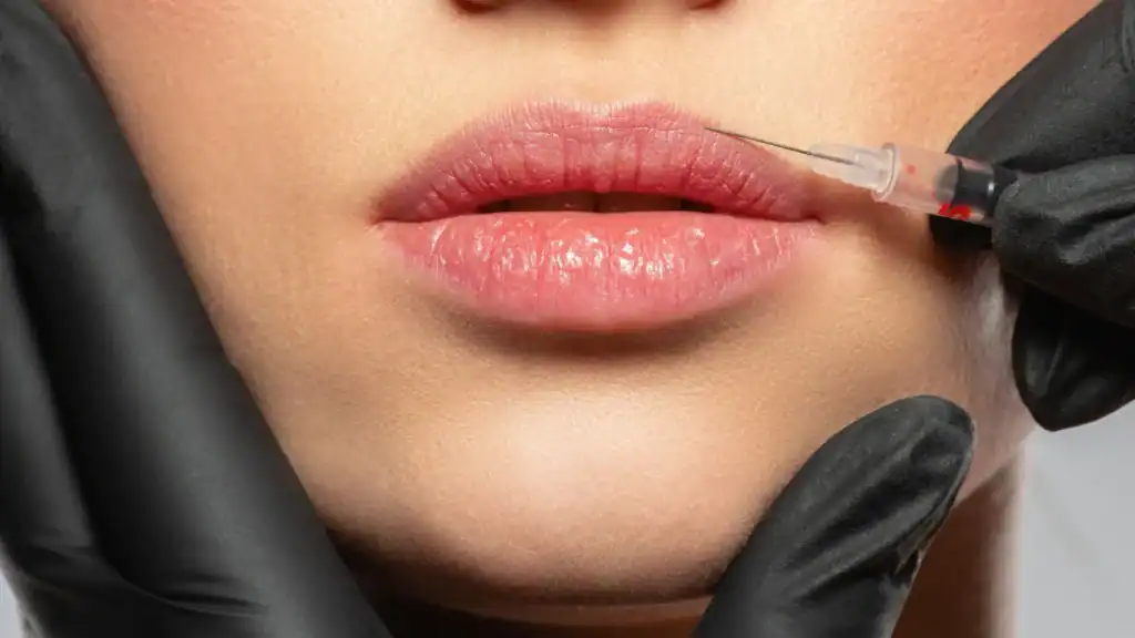 Dermal fillers in Tulum for lips, cheeks and facial contouring