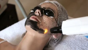 Hollywood carbon laser peel in Tulum for glowing skin