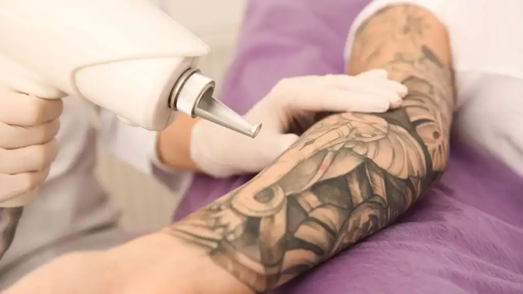 Laser tattoo removal process skin treatment