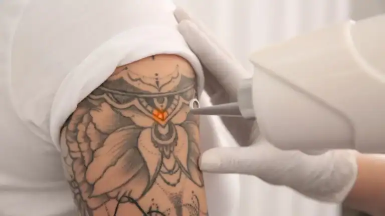 Tattoo removal with laser in Tulum